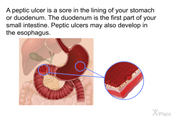 A peptic ulcer is a sore in the lining of your stomach or duodenum. The duodenum is the first part of your small intestine. Peptic ulcers may also develop in the esophagus.