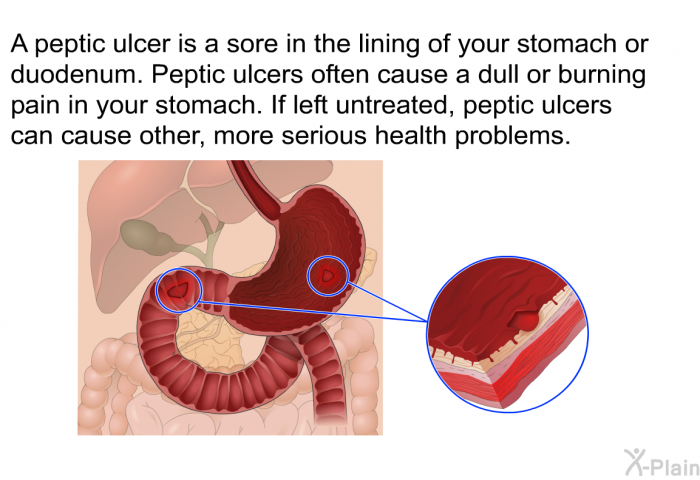 A peptic ulcer is a sore in the lining of your stomach or duodenum. Peptic ulcers often cause a dull or burning pain in your stomach. If left untreated, peptic ulcers can cause other, more serious health problems.