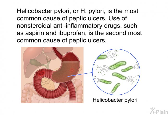 Helicobacter pylori, or H. pylori, is the most common cause of peptic ulcers. Use of nonsteroidal anti-inflammatory drugs, such as aspirin and ibuprofen, is the second most common cause of peptic ulcers.
