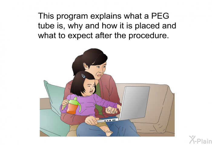 This health information explains what a PEG tube is, why and how it is placed and what to expect after the procedure.