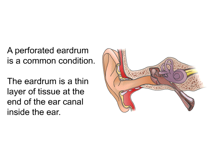A perforated eardrum is a common condition. The eardrum is a thin layer of tissue at the end of the ear canal inside the ear.