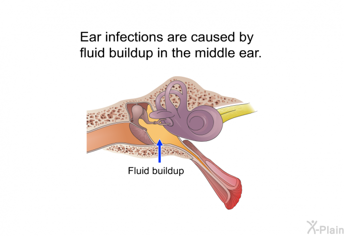 Ear infections are caused by fluid buildup in the middle ear.