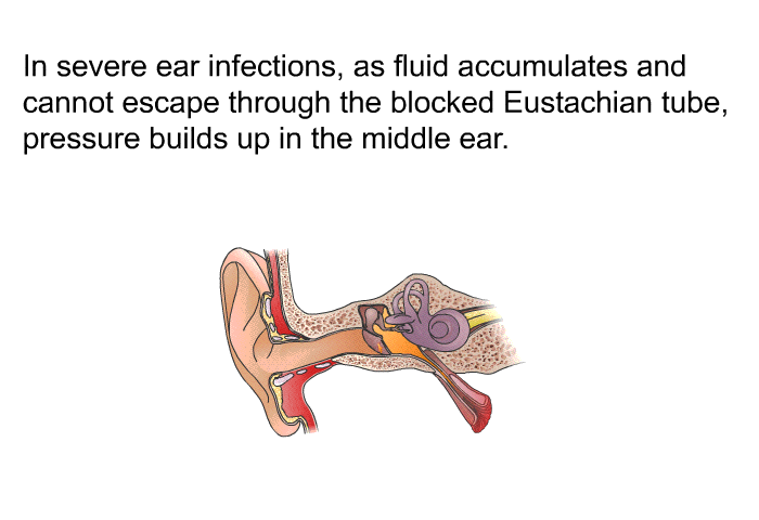 In severe ear infections, as fluid accumulates and cannot escape through the blocked Eustachian tube, pressure builds up in the middle ear.
