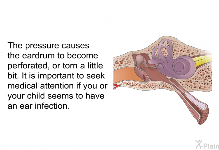 The pressure causes the eardrum to become perforated, or torn a little bit. It is important to seek medical attention if you or your child seems to have an ear infection.