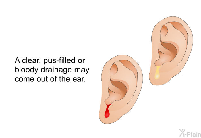 A clear, pus-filled or bloody drainage may come out of the ear.