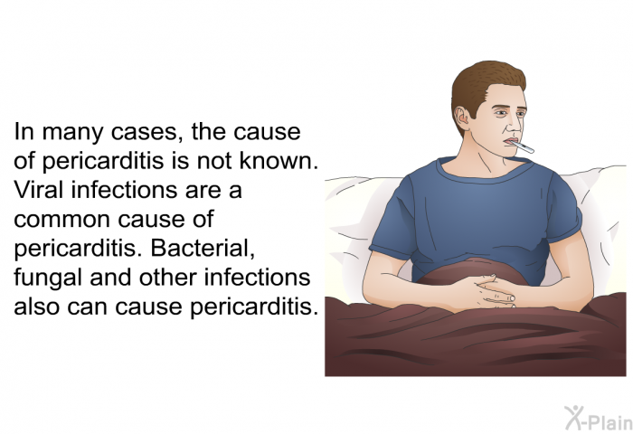 In many cases, the cause of pericarditis is not known. Viral infections are a common cause of pericarditis. Bacterial, fungal and other infections also can cause pericarditis.
