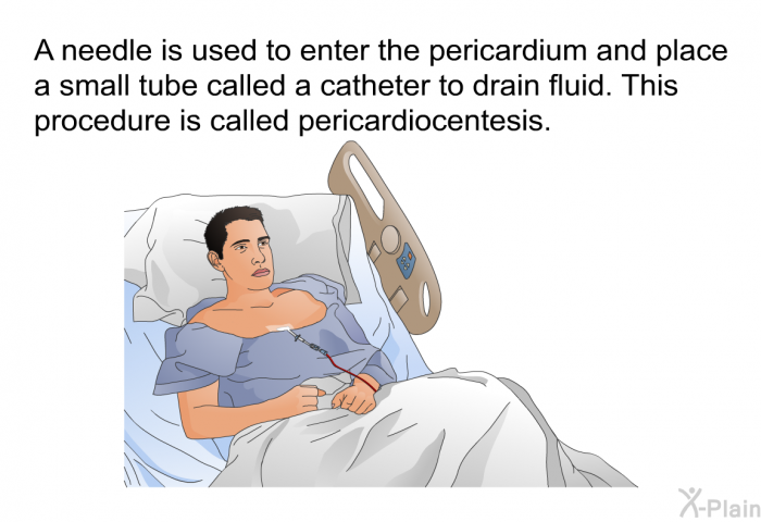 A needle is used to enter the pericardium and place a small tube called a catheter to drain fluid. This procedure is called pericardiocentesis.