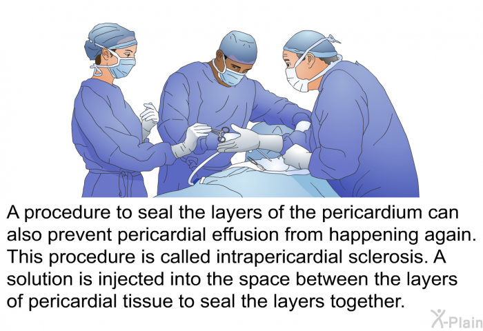 A procedure to seal the layers of the pericardium can also prevent pericardial effusion from happening again. This procedure is called intrapericardial sclerosis. A solution is injected into the space between the layers of pericardial tissue to seal the layers together.