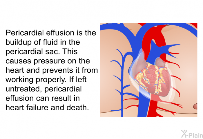 Pericardial effusion is the buildup of fluid in the pericardial sac. This causes pressure on the heart and prevents it from working properly. If left untreated, pericardial effusion can result in heart failure and death.