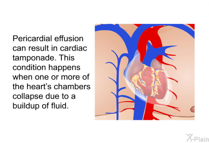 Pericardial effusion can result in cardiac tamponade. This condition happens when one or more of the heart's chambers collapse due to a buildup of fluid.