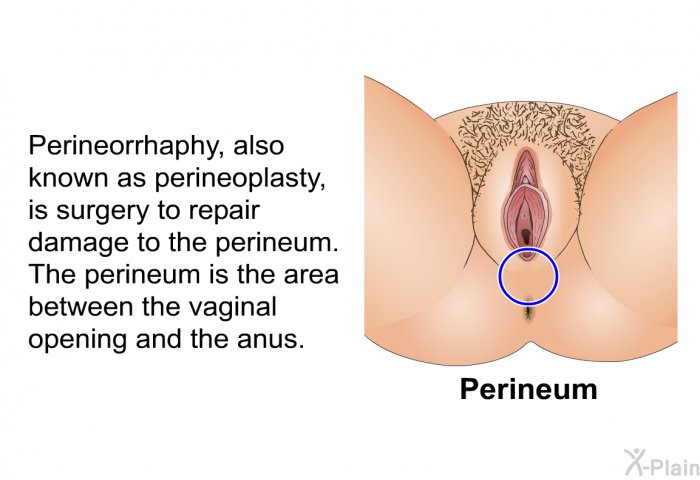 Perineorrhaphy, also known as perineoplasty, is surgery to repair damage to the perineum. The perineum is the area between the vaginal opening and the anus.