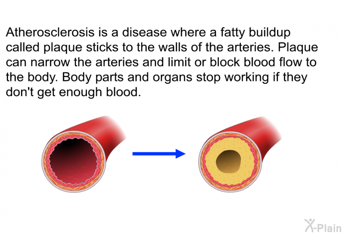 Atherosclerosis is a disease where a fatty buildup called plaque sticks to the walls of the arteries. Plaque can narrow the arteries and limit or block blood flow to the body. Body parts and organs stop working if they don't get enough blood.