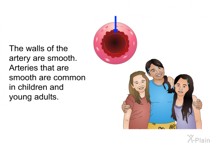 The walls of the artery are smooth. Arteries that are smooth are common in children and young adults.