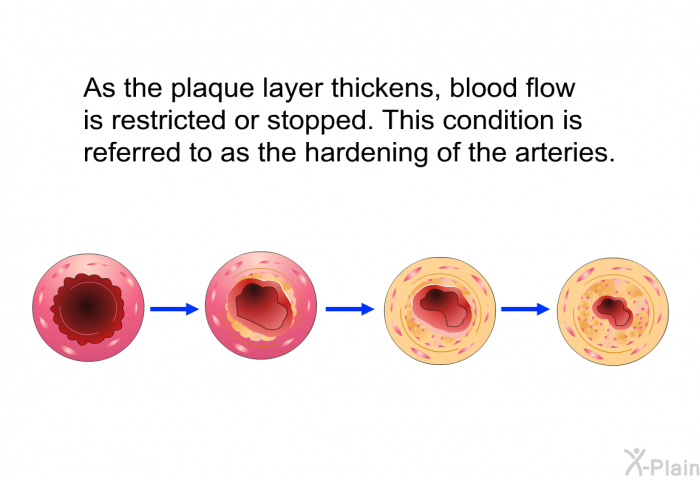 As the plaque layer thickens, blood flow is restricted or stopped. This condition is referred to as the hardening of the arteries.