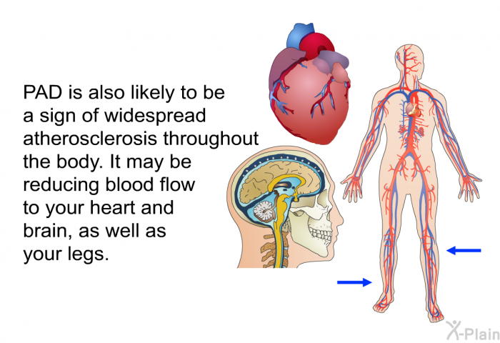 PAD is also likely to be a sign of widespread atherosclerosis throughout the body. It may be reducing blood flow to your heart and brain, as well as your legs.