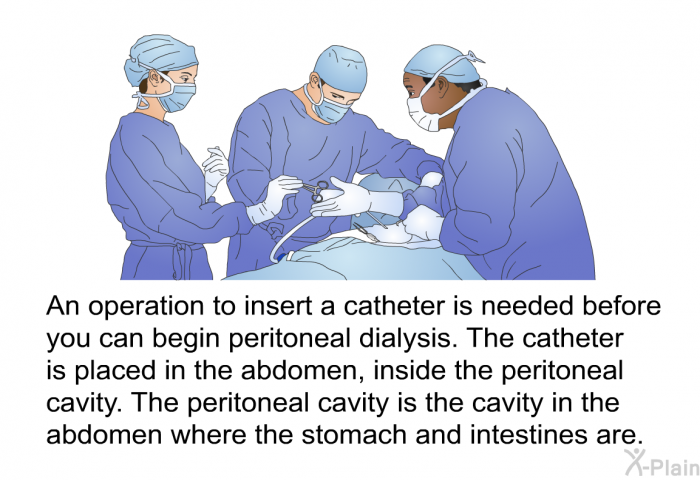 An operation to insert a catheter is needed before you can begin peritoneal dialysis. The catheter is placed in the abdomen, inside the peritoneal cavity. The peritoneal cavity is the cavity in the abdomen where the stomach and intestines are.
