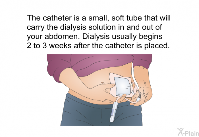 The catheter is a small, soft tube that will carry the dialysis solution in and out of your abdomen. Dialysis usually begins 2 to 3 weeks after the catheter is placed.