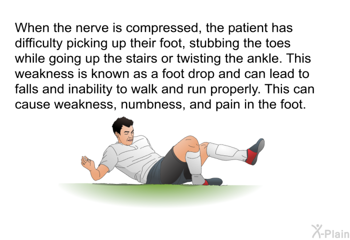 When the nerve is compressed, the patient has difficulty picking up their foot, stubbing the toes while going up the stairs or twisting the ankle. This weakness is known as a foot drop and can lead to falls and inability to walk and run properly. This can cause weakness, numbness, and pain in the foot.