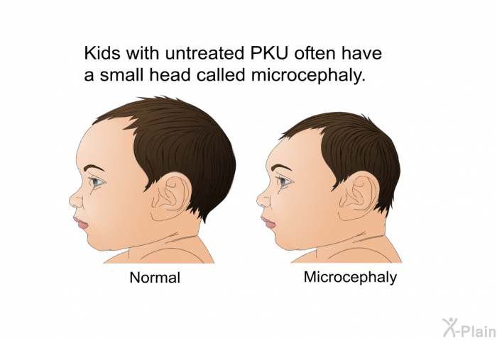 Kids with untreated PKU often have a small head called microcephaly.