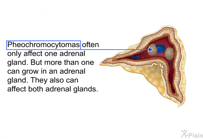 Pheochromocytomas often only affect one adrenal gland. But more than one can grow in an adrenal gland. They also can affect both adrenal glands.