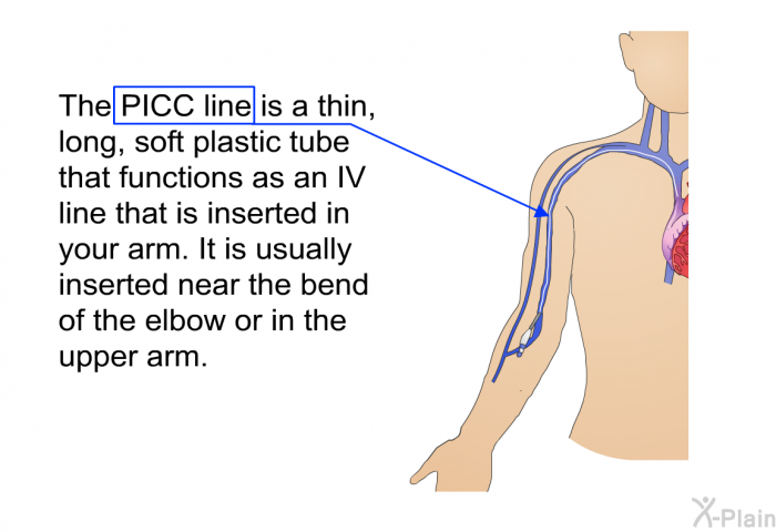 The PICC line is a thin, long, soft plastic tube that functions as an IV line that is inserted in your arm. It is usually inserted near the bend of the elbow or in the upper arm.