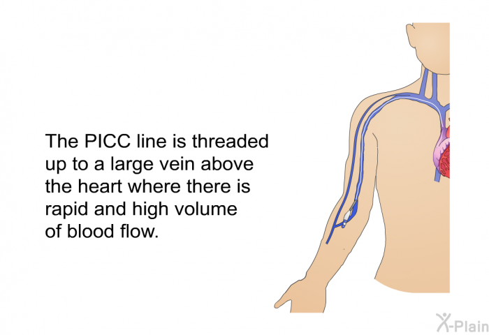 The PICC line is threaded up to a large vein above the heart where there is rapid and high volume of blood flow.