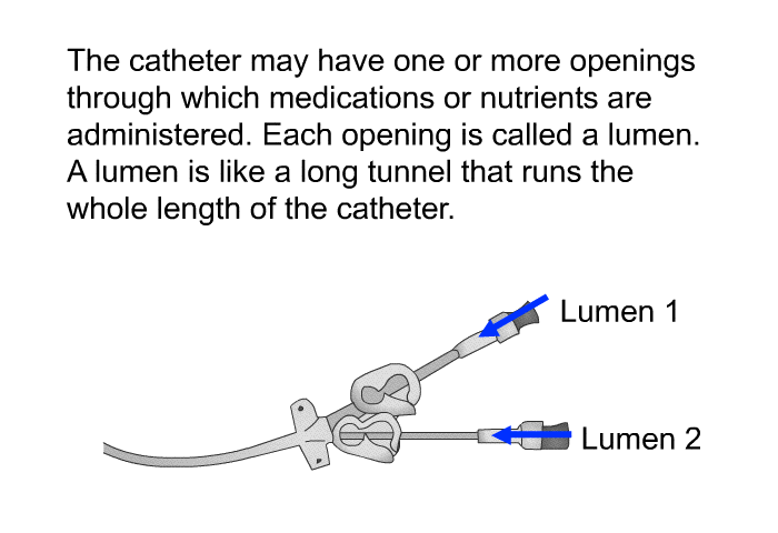 The catheter may have one or more openings through which medications or nutrients are administered. Each opening is called a lumen. A lumen is like a long tunnel that runs the whole length of the catheter.