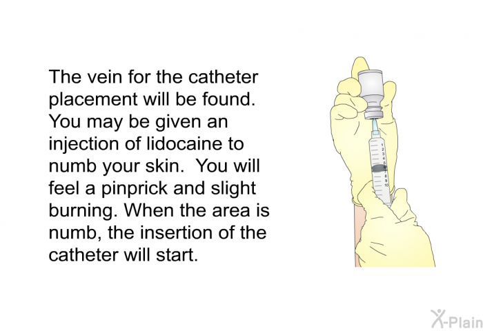 The vein for the catheter placement will be found. You may be given an injection of lidocaine to numb your skin. You will feel a pinprick and slight burning. When the area is numb, the insertion of the catheter will start.
