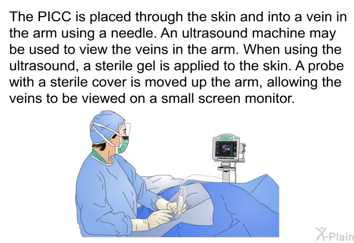 The PICC is placed through the skin and into a vein in the arm using a needle. An ultrasound machine may be used to view the veins in the arm. When using the ultrasound, a sterile gel is applied to the skin. A probe with a sterile cover is moved up the arm, allowing the veins to be viewed on a small screen monitor.