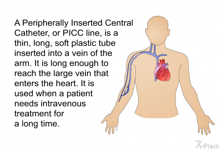 A Peripherally Inserted Central Catheter, or PICC line, is a thin, long, soft plastic tube inserted into a vein of the arm. It is long enough to reach the large vein that enters the heart. It is used when a patient needs intravenous treatment for a long time.