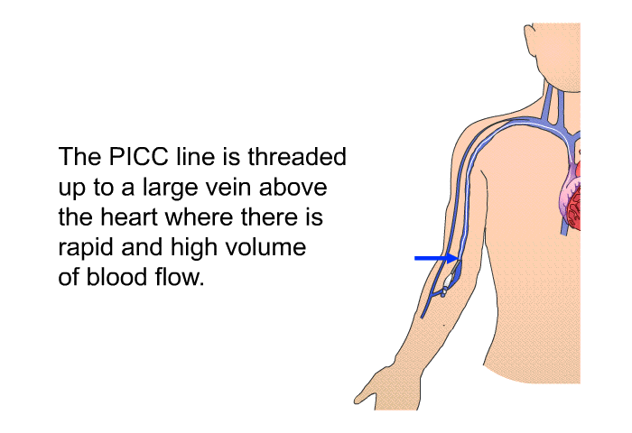 The PICC line is threaded up to a large vein above the heart where there is rapid and high volume of blood flow.