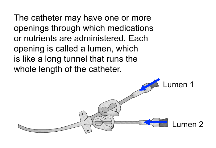 The catheter may have one or more openings through which medications or nutrients are administered. Each opening is called a lumen, which is like a long tunnel that runs the whole length of the catheter.