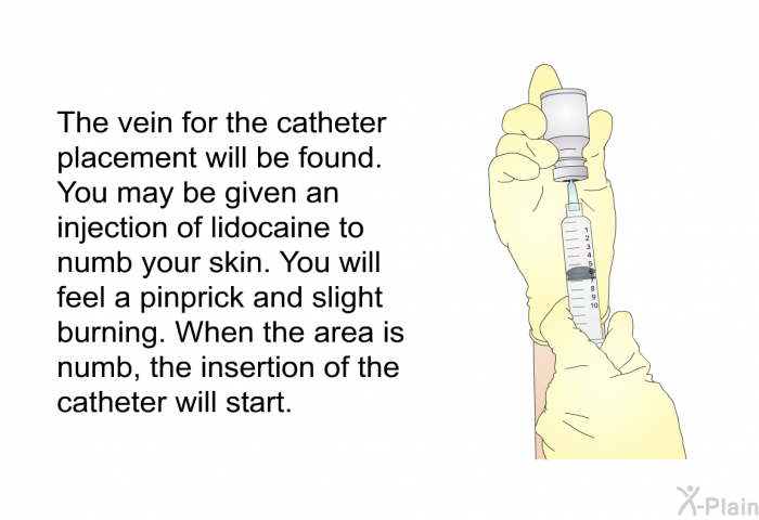 The vein for the catheter placement will be found. You may be given an injection of Lidocaine to numb your skin. You will feel a pinprick and slight burning. When the area is numb, the insertion of the catheter will start.