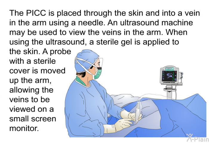 The PICC is placed through the skin and into a vein in the arm using a needle. An ultrasound machine may be used to view the veins in the arm. When using the ultrasound, a sterile gel is applied to the skin. A probe with a sterile cover is moved up the arm, allowing the veins to be viewed on a small screen monitor.