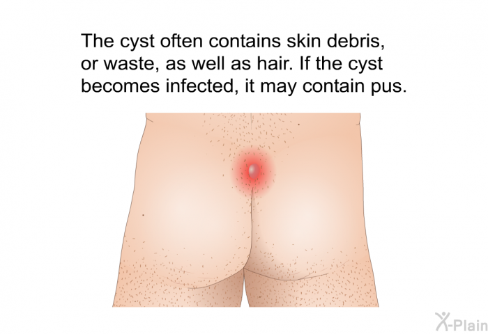 The cyst often contains skin debris, or waste, as well as hair. If the cyst becomes infected, it may contain pus.
