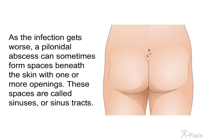 As the infection gets worse, a pilonidal abscess can sometimes form spaces beneath the skin with one or more openings. These spaces are called sinuses, or sinus tracts.