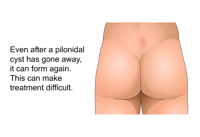 Even after a pilonidal cyst has gone away, it can form again. This can make treatment difficult.