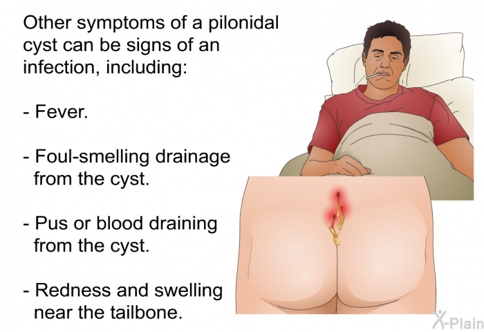 Other symptoms of a pilonidal cyst can be signs of an infection, including:  Fever. Foul-smelling drainage from the cyst. Pus or blood draining from the cyst. Redness and swelling near the tailbone.