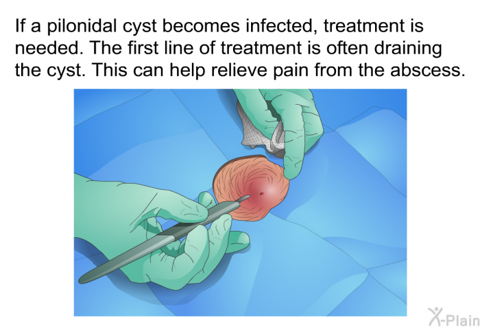 If a pilonidal cyst becomes infected, treatment is needed. The first line of treatment is often draining the cyst. This can help relieve pain from the abscess.