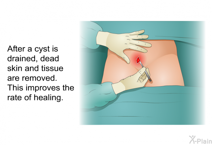 After a cyst is drained, dead skin and tissue are removed. This improves the rate of healing.