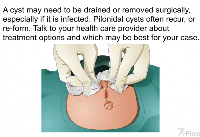 PatEdu Pilonidal Cyst