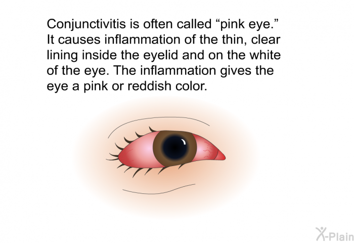 Conjunctivitis is often called “pink eye.” It causes inflammation of the thin, clear lining inside the eyelid and on the white of the eye. The inflammation gives the eye a pink or reddish color.