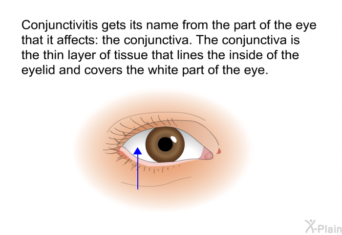 Conjunctivitis gets its name from the part of the eye that it affects: the conjunctiva. The conjunctiva is the thin layer of tissue that lines the inside of the eyelid and covers the white part of the eye.