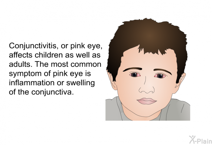 Conjunctivitis, or pink eye, affects children as well as adults. The most common symptom of pink eye is inflammation or swelling of the conjunctiva.