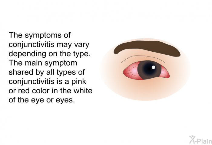 The symptoms of conjunctivitis may vary depending on the type. The main symptom shared by all types of conjunctivitis is a pink or red color in the white of the eye or eyes.
