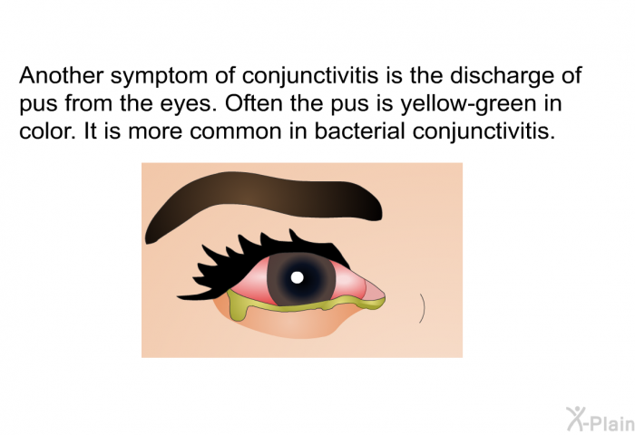 Another symptom of conjunctivitis is the discharge of pus from the eyes. Often the pus is yellow-green in color. It is more common in bacterial conjunctivitis.