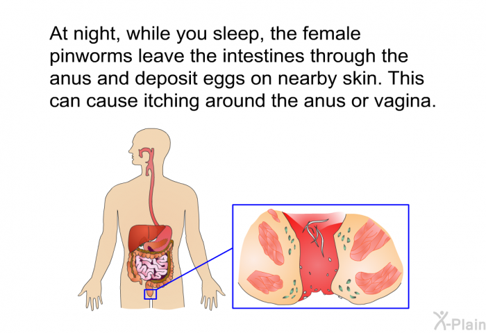 At night, while you sleep, the female pinworms leave the intestines through the anus and deposit eggs on nearby skin. This can cause itching around the anus or vagina.