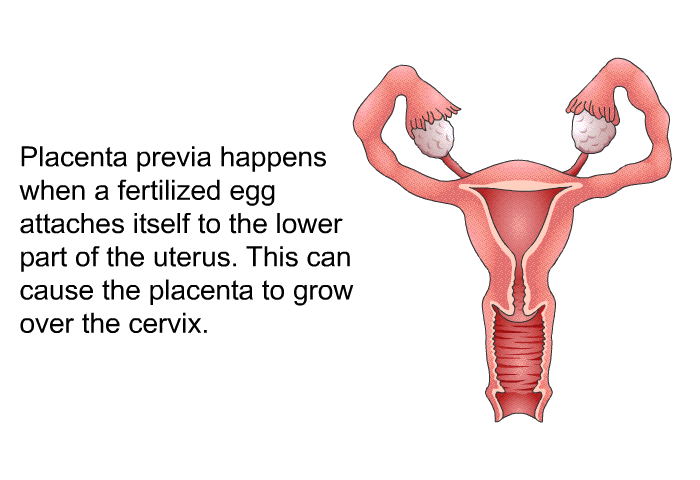 Placenta previa happens when a fertilized egg attaches itself to the lower part of the uterus. This can cause the placenta to grow over the cervix.