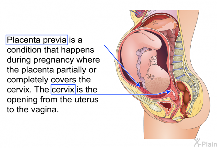 Placenta previa is a condition that happens during pregnancy where the placenta partially or completely covers the cervix. The cervix is the opening from the uterus to the vagina.