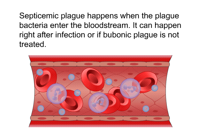 Septicemic plague happens when the plague bacteria enter the bloodstream. It can happen right after infection or if bubonic plague is not treated.